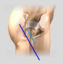 Minimally_Invasive_Knee_Replacement_Incisions