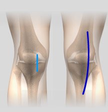 Minimally Invasive Hip Replacement Incisions